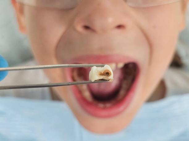Best Emergency Broken Tooth Repair in Eyota, MN